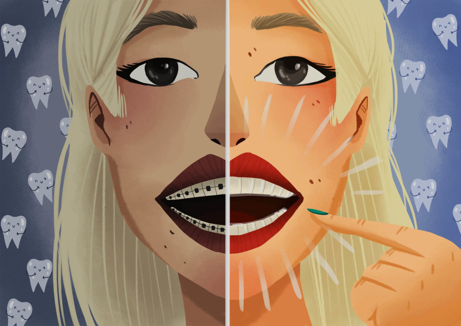 Illustration of a woman with braces and Invisalign on each half of her smile to show the aesthetic benefit of Invisalign clear aligners