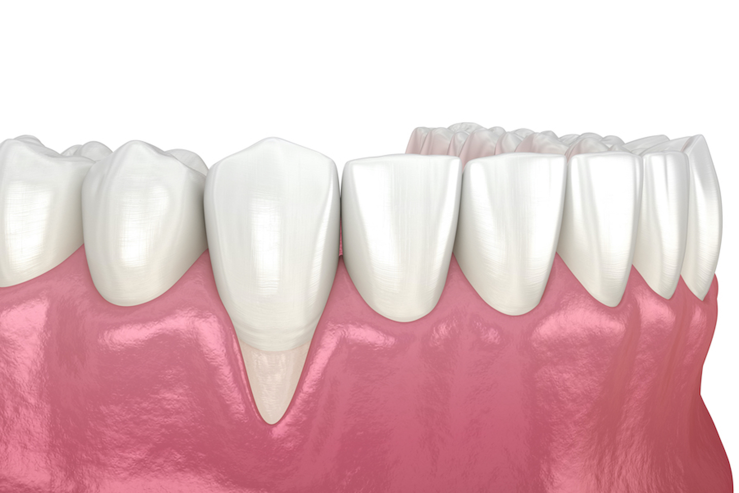 Closeup of receding gums around a loose tooth