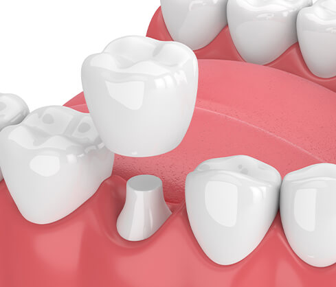 illustration of a dental crown