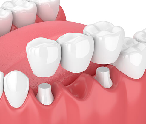 illustration of a dental bridge