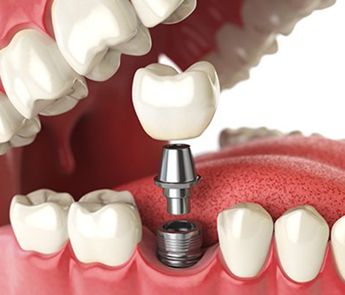 illustration of dental implant