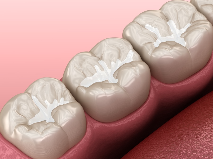 dental sealants on molar to prevent cavities