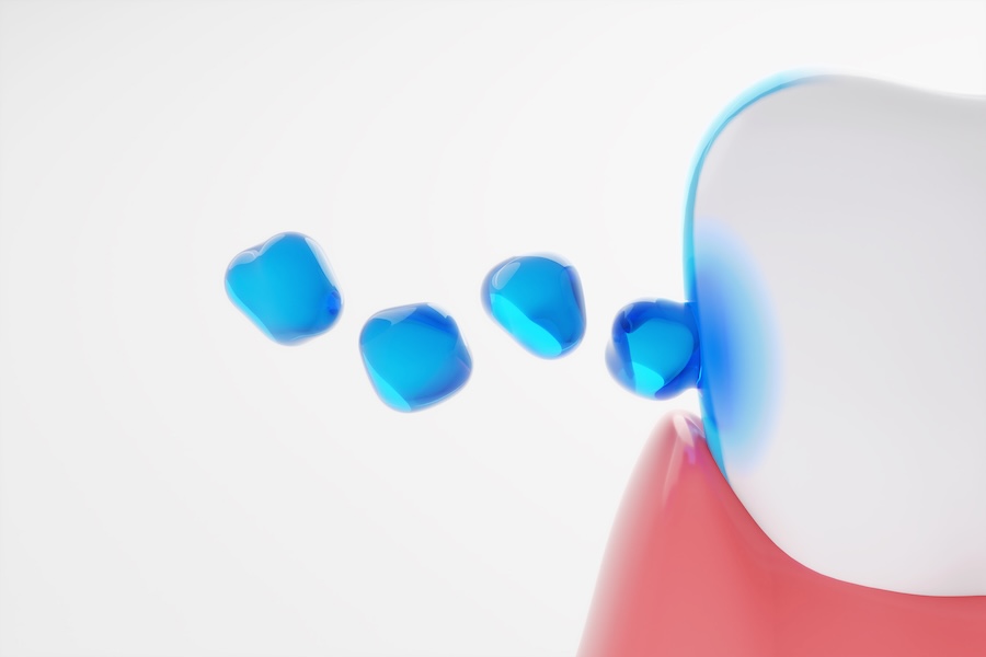 fluoride treatment on tooth preventing cavities and helping with sensitivity