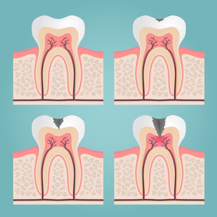 what happens if you ignore a small cavity? decay cavity