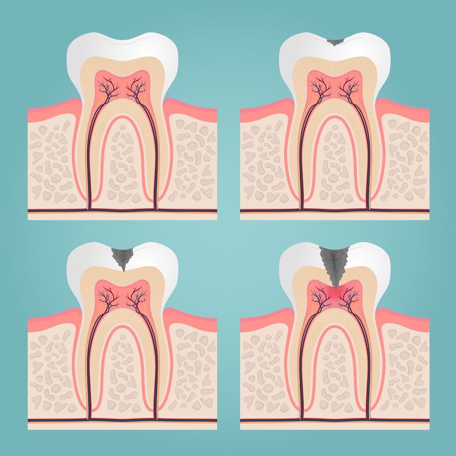 what happens if you ignore a small cavity? decay cavity