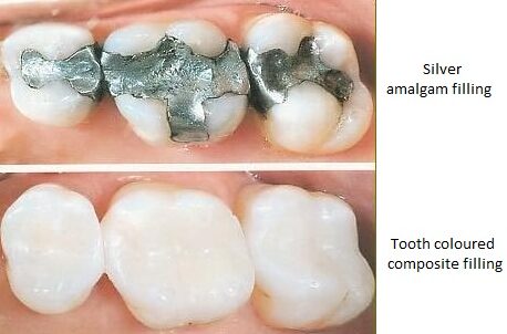 tooth colored fillings or silver amalgam fillings