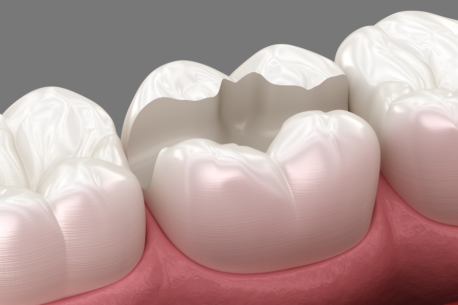 missing dental filling or crown on tooth